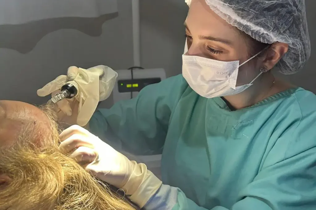 Alopecia: Tipos, Causas e Tratamento pelo SUS no Paraná